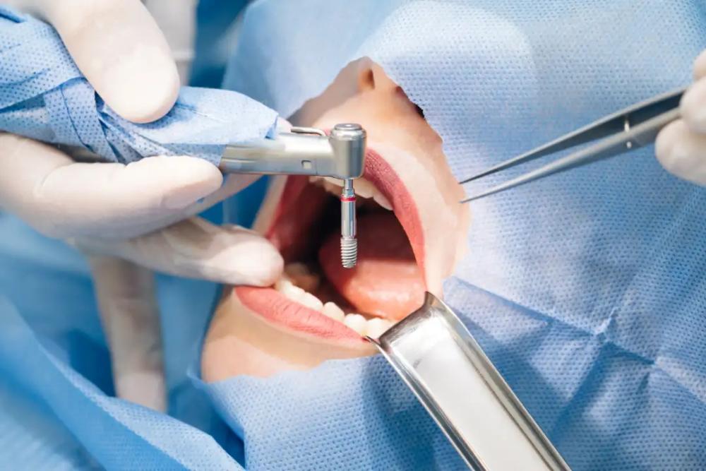 Dental Implants Myaree Dental Implants Myaree
