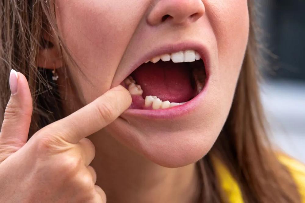 Tooth Extraction Perth Tooth Extraction Perth