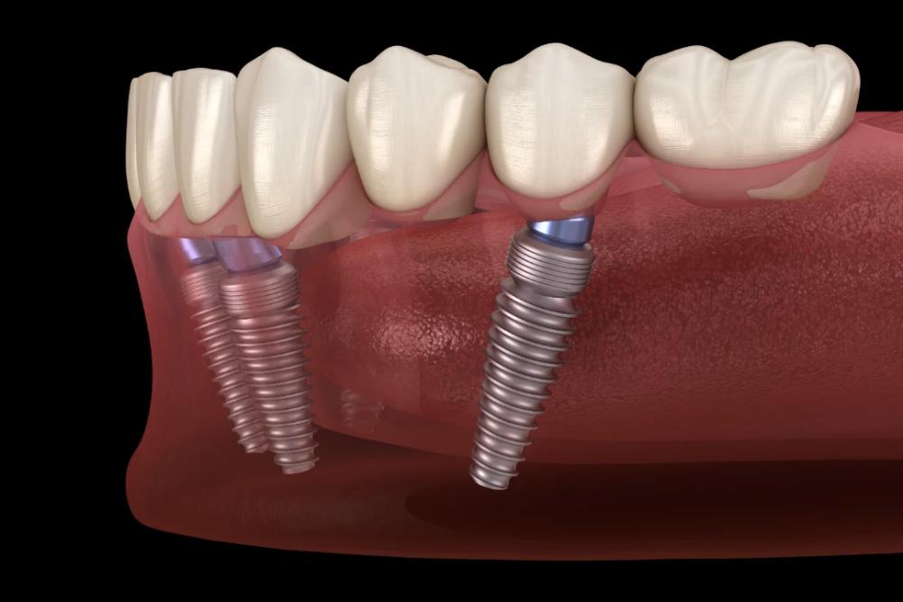 Dental Implants Applecross Dental Implants Applecross
