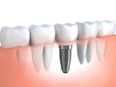 diagram of best dental implants in perth
