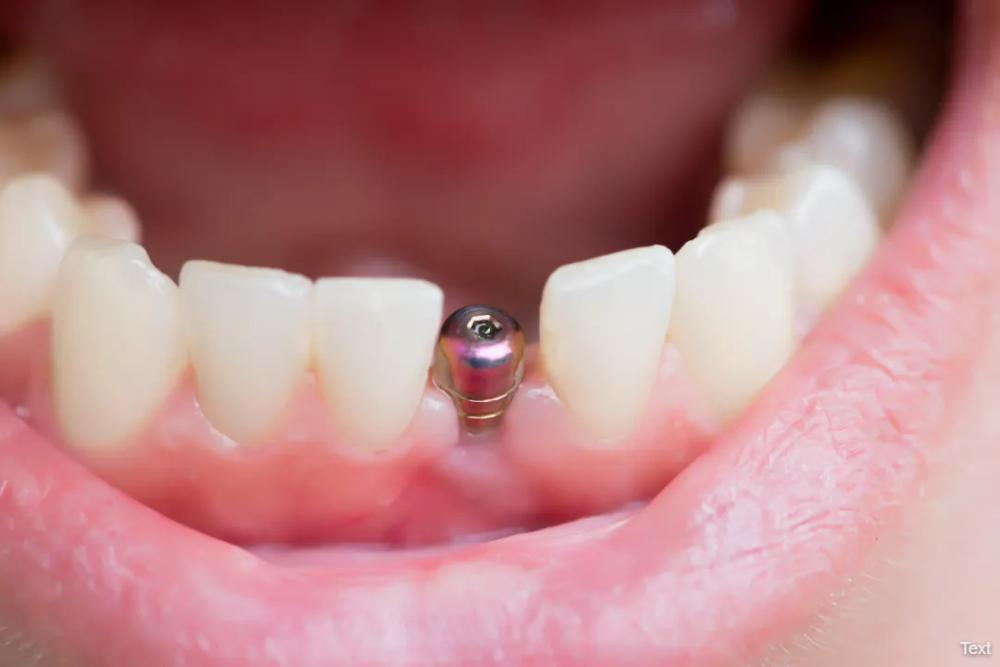 Dental Implants Palmyra Dental Implants Palmyra