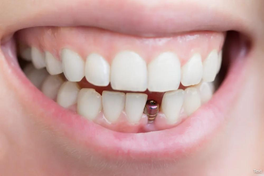 Dental Implants Palmyra Dental Implants Palmyra