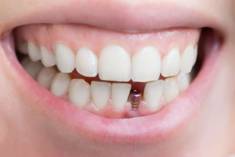 Dental Implants Perth Dental Implants Perth