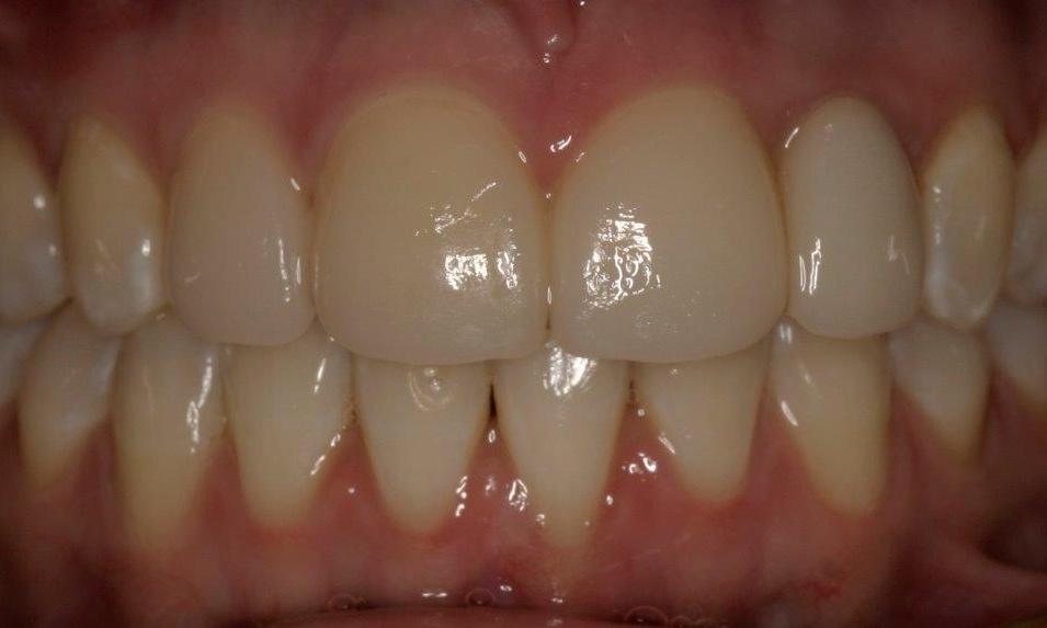 Veneer After Photo | Booragoon Dentist