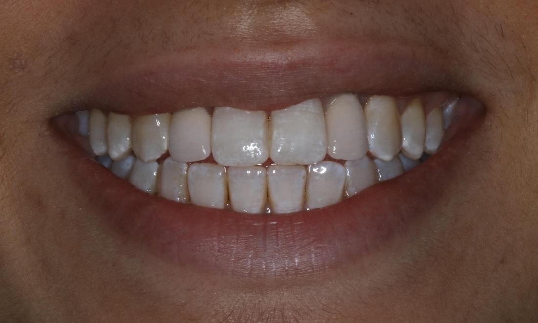 patient after dental implants booragoon