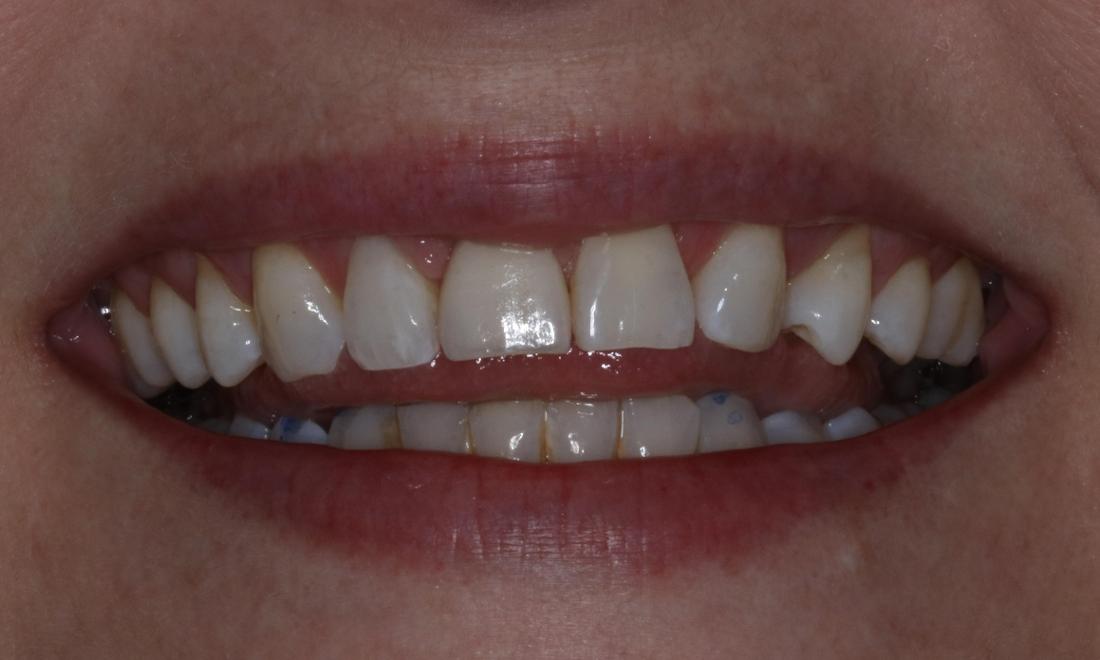 Dental Implant & Crown After Photo