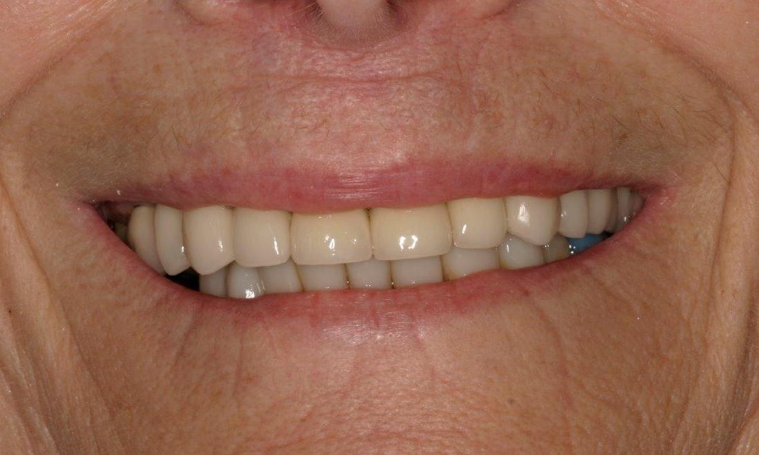 Patient After crowns and bridges | Mount Pleasant Dentist