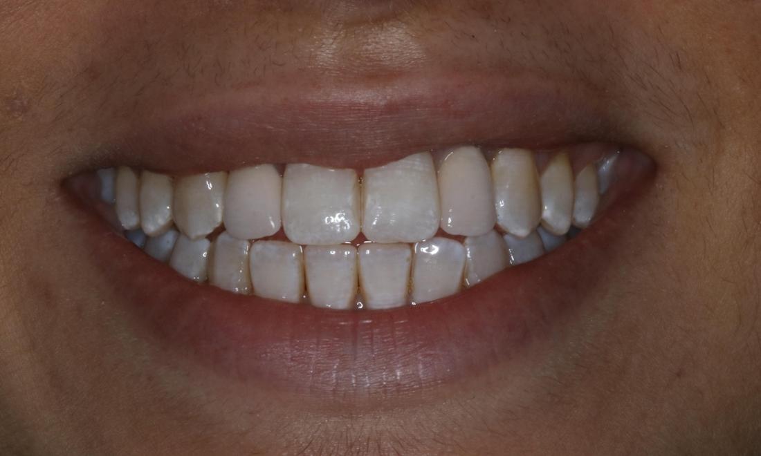 Dental Implants After Photo Booragoon