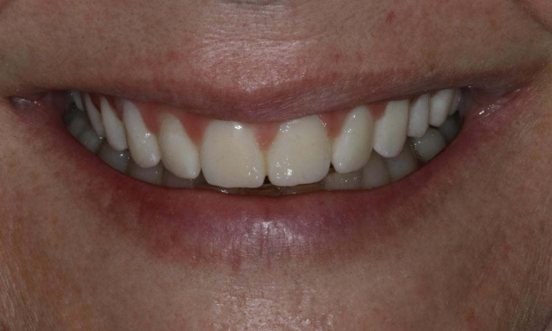 Dental Implants After Photo Booragoon