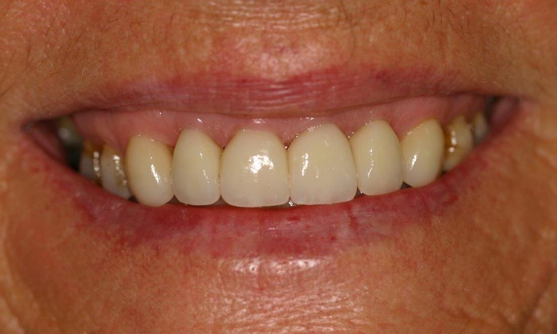Dental Crowns Before & After | Alfred Cove Dentist