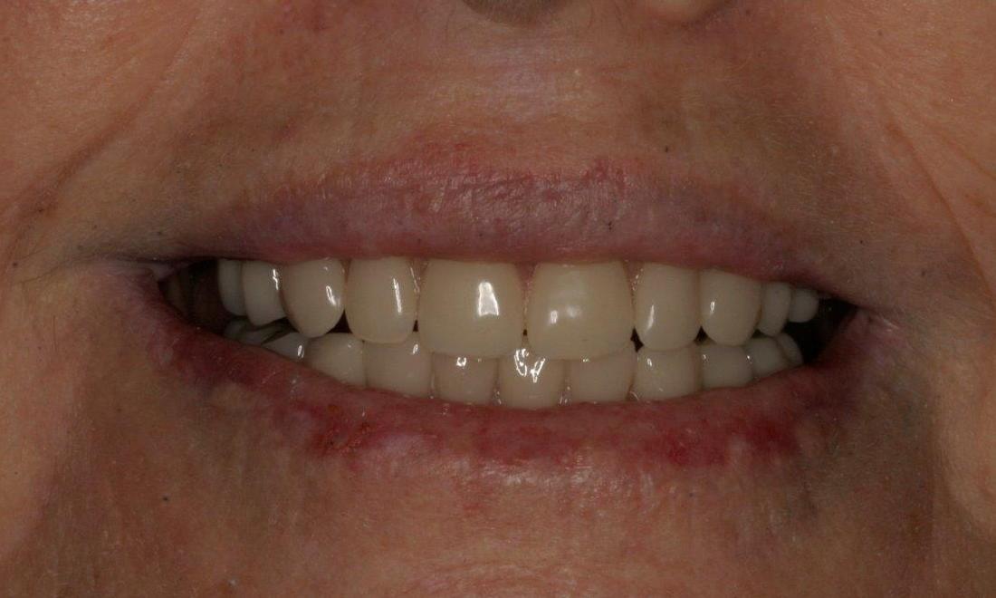 Dental Implants After | Mount Pleasant