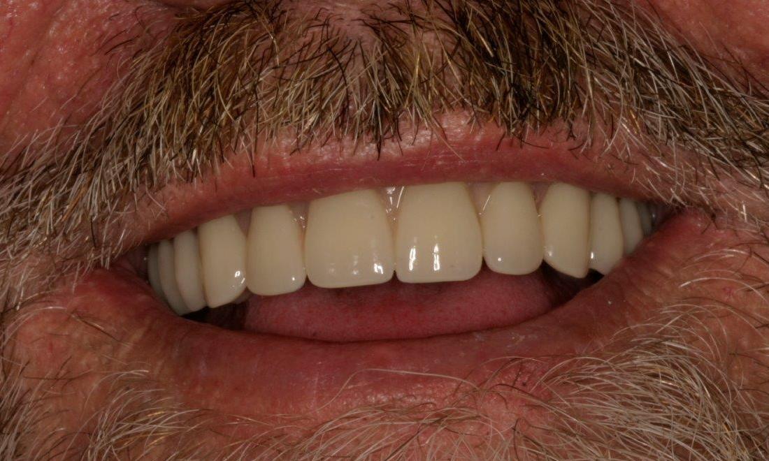 Patient after dental implants | booragoon wa