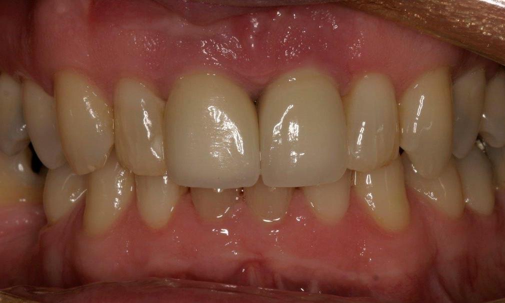 New Dental Implant | Booragoon Dentist