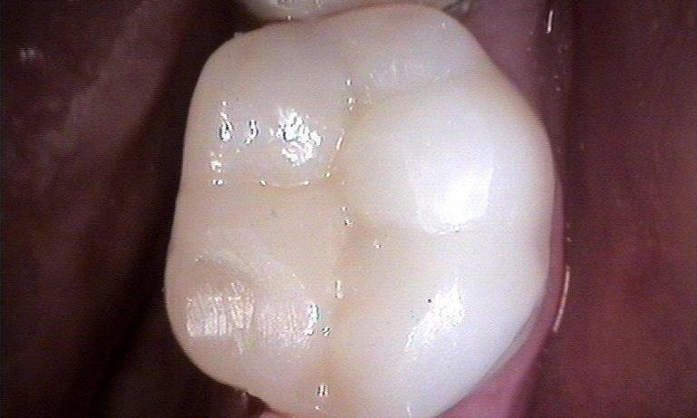 Tooth Colored Filling | Booragoon WA Dentist