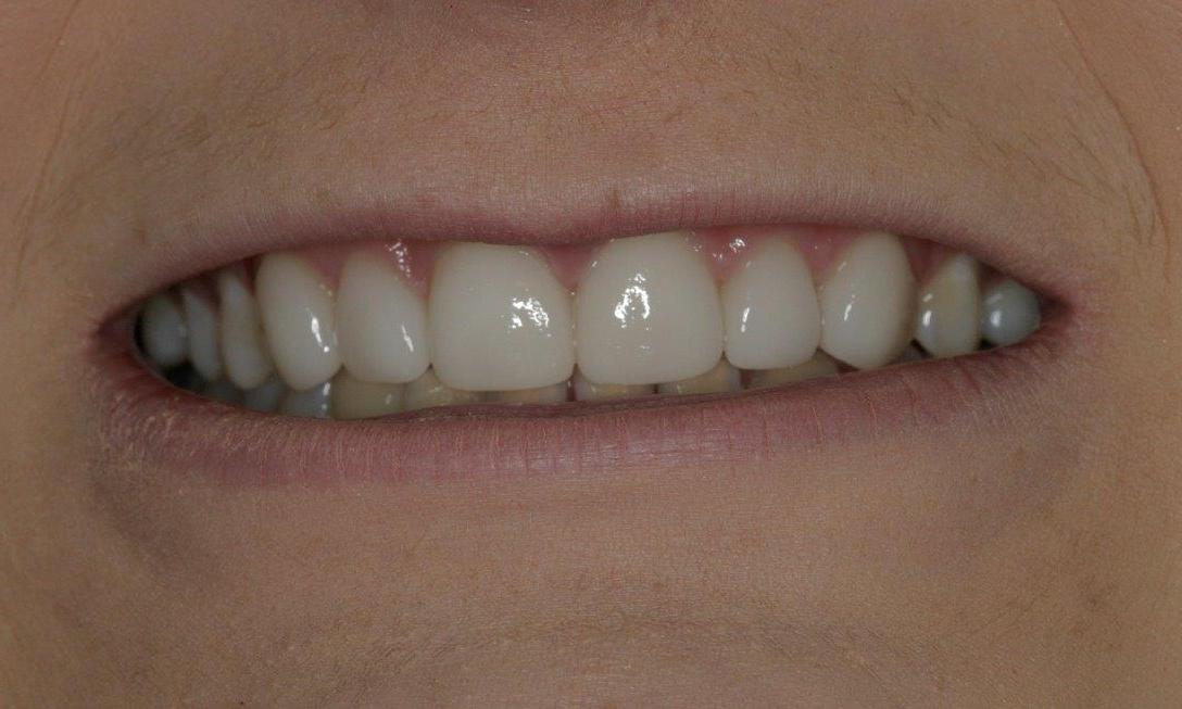 New Veneers photo | Booragoon Dentist