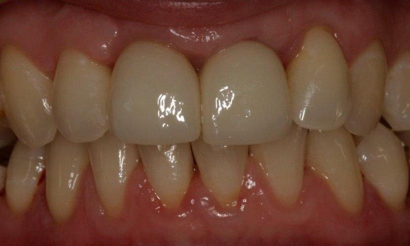 Dental Crown | Booragoon Dental Implants