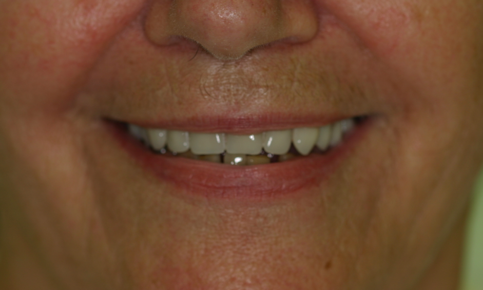 Dentures After Photo | Booragoon, WA