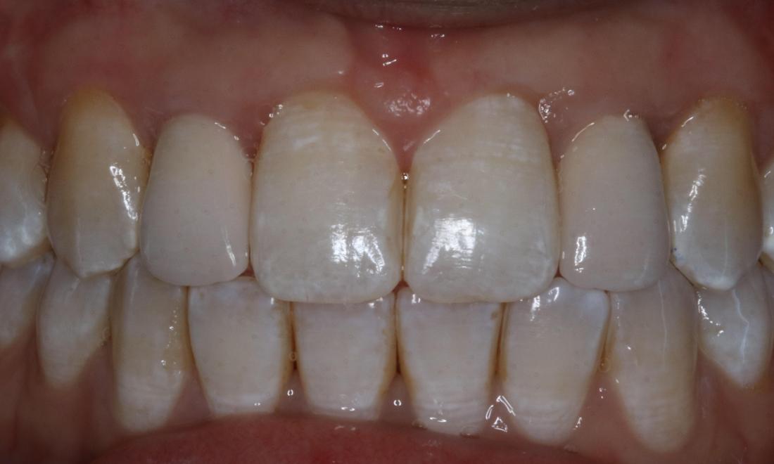 Patient with new dental implants in Booragoon