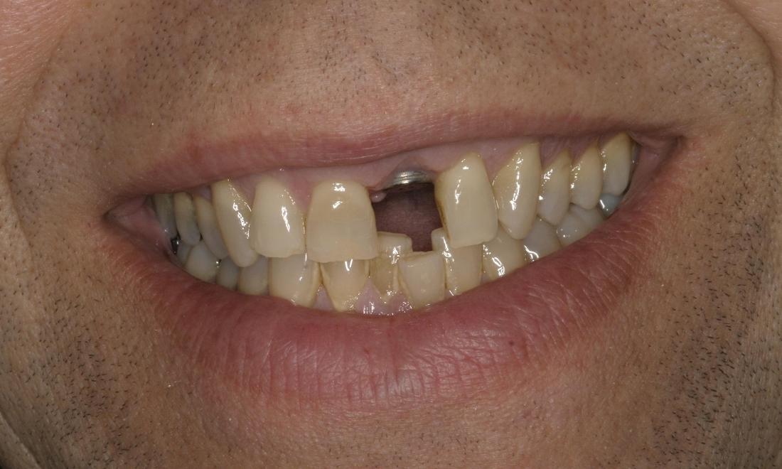 Patient before a new implant and crown 