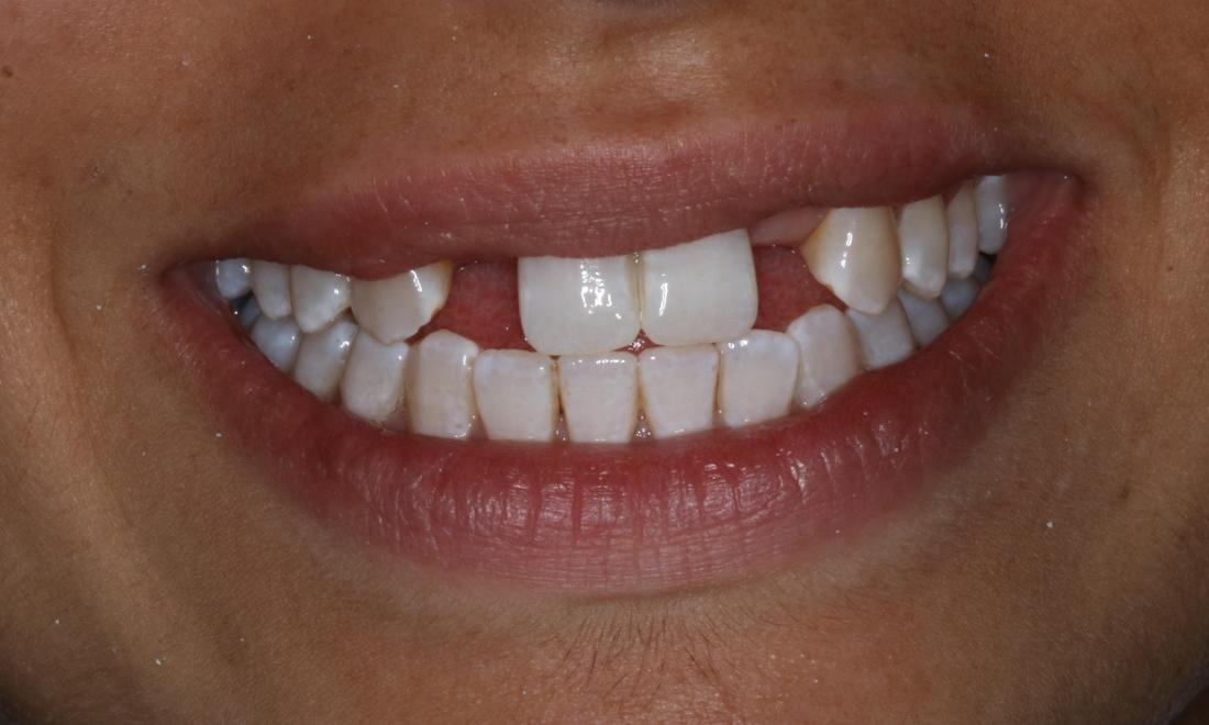 Patient before dental implants booragoon