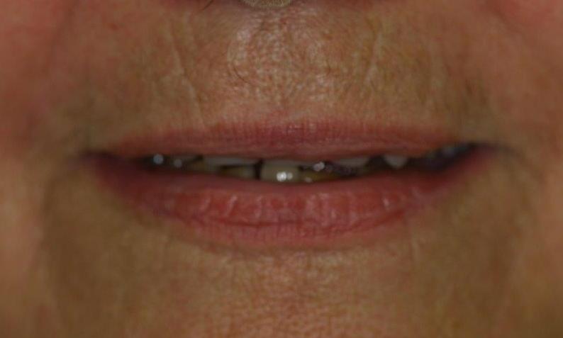 Patient Before Dentures | Booragoon, WA