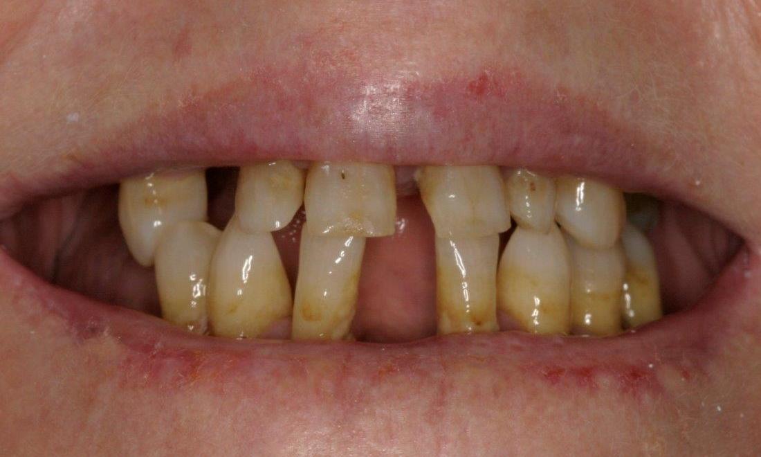 Dental Implants Before | Mount Pleasant