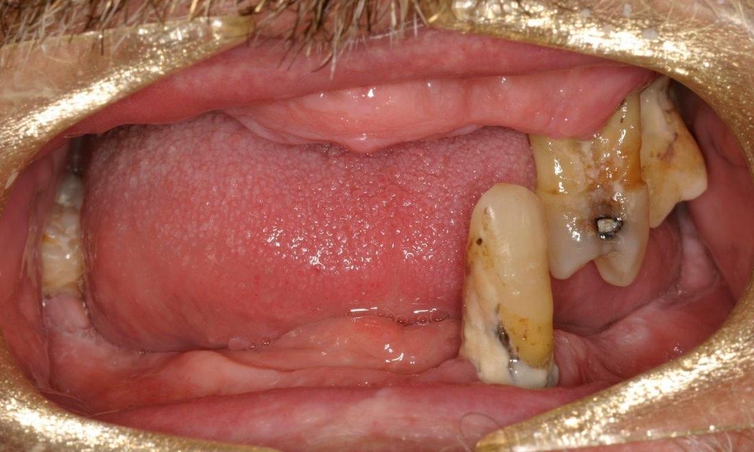 Patient Before Dental Implants | Booragoon WA