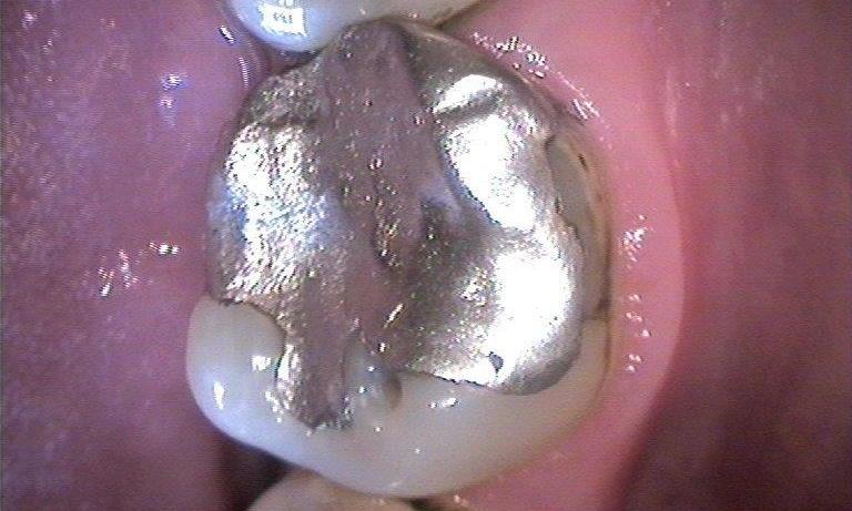 Silver Filling | Booragoon WA Dentist