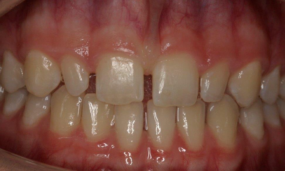 Patient before veneers | Booragoon Cosmetic Dentist