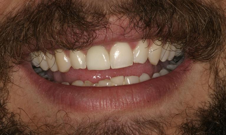 Dental Implant | Booragoon Dentist